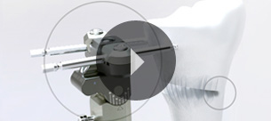 Fixus 88 - Osteotomia tibial